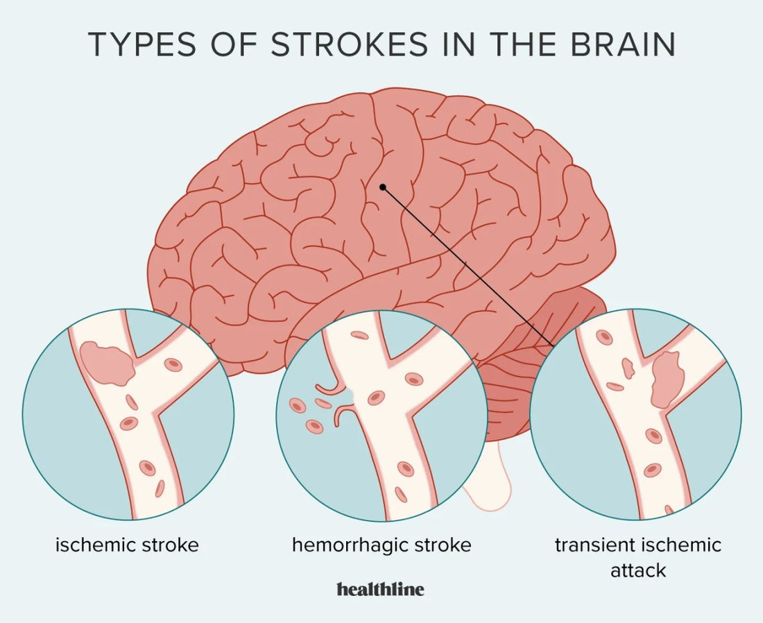 Understanding Stroke: Advice and Treatment Options