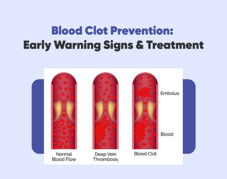 What Are the Five Warning Signs of a Blood Clot?