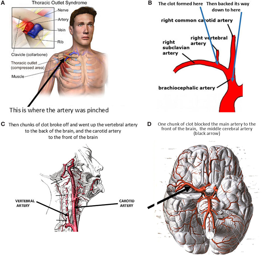Can a person be normal after a stroke?